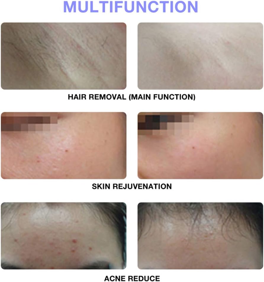 Permanent IPL Hair Removal