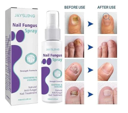 Antifungal Nail Treatment Spray