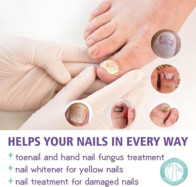 Antifungal Nail Treatment Spray