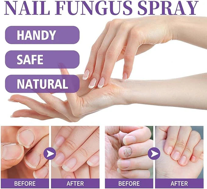 Antifungal Nail Treatment Spray